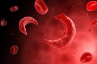 ލޭގެ އެހެން ބައްޔެއް، ސިކްލް ސެލް އަށް ސަމާލުވޭ!