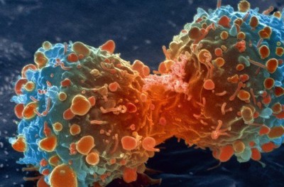 ކެންސަރުގެ ފަރުވާ އަށް ދުވާލަކު ދެ ލައްކައެއްހާ ރުފިޔާ!