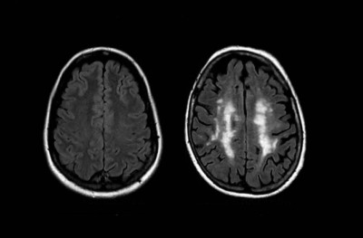 މާބޮޑަށް ފަލަ މީހުންގެ ސިކުނޑި 10 އަހަރު މުސްކުޅި