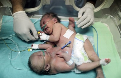 އެއް ހަށިގަނޑުން ގުޅިފައިވާ ގާޒާގެ ދެ ކުދިން ނުރައްކަލުގައި