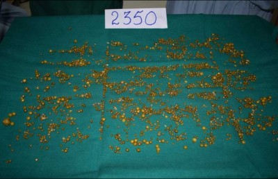 އިންޑިއާ އަންހެނެއްގެ ގޮހޮރުން 2،000 އަށް ވުރެ ގިނަ ހިލަކޮޅު ނަގައިފި