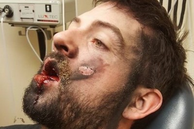 އީ ސިނގިރެޓެއް ގޮވުމުގެ ސަބަބުން އެމެރިކާ މީހަކަށް ސީރިއަސް އަނިޔާތަކެއް ލިބިއްޖެ