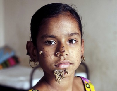 "ޓްރީ މޭން" ސިންޑްރޯމްގެ ޝިކާރައަކަށްވި އަންހެން ކުއްޖާގެ ކާމިޔާބު އޮޕަރޭޝަނެއް ކޮށްފި