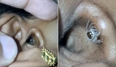 މީހެއްގެ ކަންފަތުން ފައިދިގު މަކުނެއް ނަގައިފި