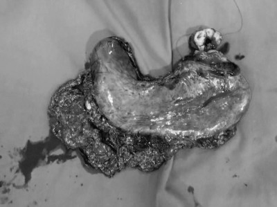 ކެންސަރު ޖެހިފައިވާ މައިދާއެއް ވަކިކޮށް، ރާއްޖޭގައި ފުރަތަމަ ފަހަރަށް ކާމިޔާބު ބޮޑު އޮޕަރޭޝަނެއް ކޮށްފި