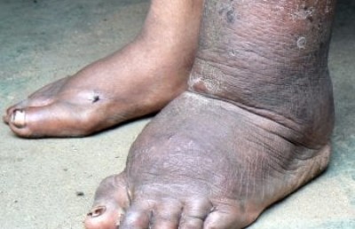 ފައިލޭރިޔާ ބަލި ޖެހިފައިވާ ބަޔަކު ކުޅުދުއްފުށިން ފެނިއްޖެ