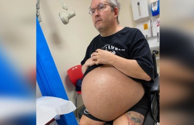 ޔޫކޭ މީހެއްގެ ކިޑްނީ އާދަޔާ ހިލާފަށް ބޮޑުވެ ނަގަން ޖެހިއްޖެ