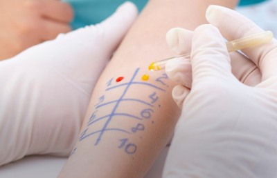 ޓްރީޓޮޕުން ސްކިން އެލާޖީގެ ހާއްސަ ޓެސްޓަކާއި ތެރަޕީއެއް