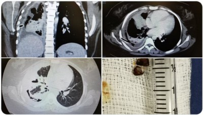 ސުޕާރީ ފުކެއްގެ ސަބަބުން ފުރާނަ ނުރައްކަލަކަށް!