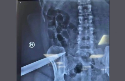 އަނބިމީހާ ގަޔަށް ވަޅިހެރި މީހާ ބުނީ އަމިއްލަ ބަނޑަށް ވަޅި ހެރީ ބިރުން ކަމަށް