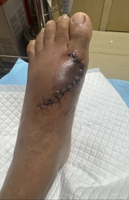 ސައިކަލުގެ ޕެޑަލްއަކުން ޖެހި ފަޔަށް ބޮޑު އަނިޔާއެއް