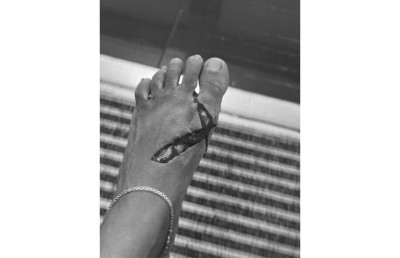 ސައިކަލުގެ ޕެޑަލްއަކުން ޖެހި ފަޔަށް ބޮޑު އަނިޔާއެއް