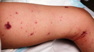 ނުރައްކާތެރި ބައްޔެއްކަމަށްވާ މެނިންގޮކޯކަލް ރާއްޖެއިން ފެނިއްޖެ