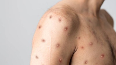 އިންޑިއާގައި މީހަކަށް މަކުނު ވިދުރި ޖެހިފައިވާ ކަމަށް ޝައްކުވެ، އެކަހެރިކޮށްފި