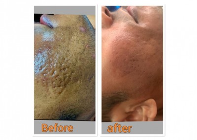 އެޑްވަޓޯރިއަލް: ހަމުގެ މައްސަލަތަކަށް ނަތީޖާ ރަނގަޅު، ޑރ. ބެލްޓާގެ ޓްރީޓުމަންޓުތައް ވަރެއް ހަމަ ނެތް