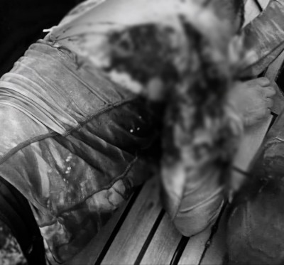 މިޔަރެއްގެ ހަމަލާގައި ކޮނޑުހުޅު ނެއްޓި ފުން ޒަޚަމްތަކެއް؛ ފަރުވާއަށް ކުޅުދުއްފުށިން މާލެ ގެންނަނީ