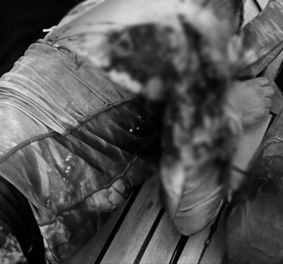 މިޔަރު ހަމަލާގައި ފުން ޒަޚަމްތަކެއް ލިބުނު މީހާގެ ހާލު ރަނގަޅު، ފަރުވާދެނީ ވޯޑުގައި